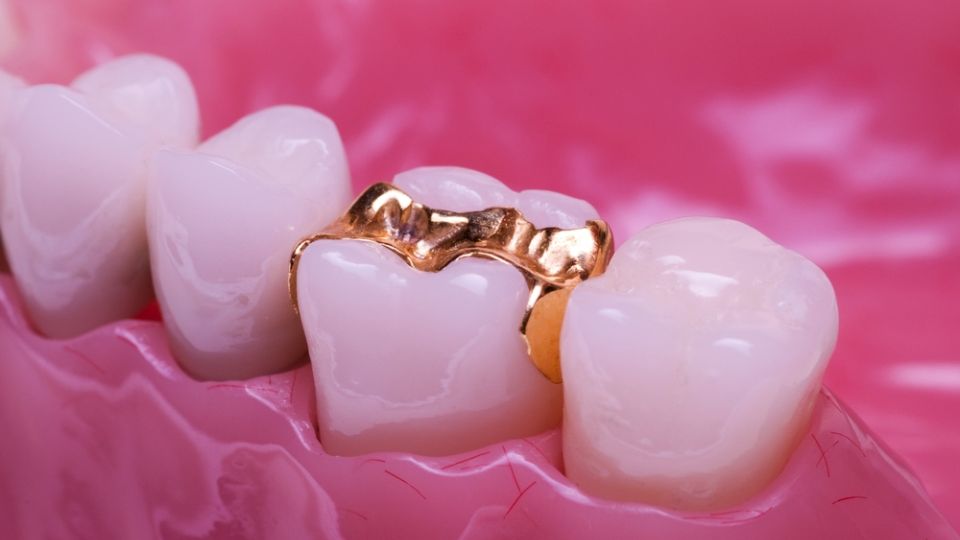Dental Onlays in Thane | Dr. Saurabh Pakhale | Elite Dermadent 1 Looking for dental onlays in Thane? Visit Dr. Saurabh Pakhale at Elite Dermadent for expert care, modern technology & natural-looking results.