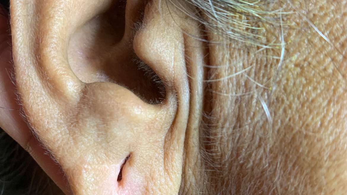 Ear Lobe Repair in Thane | Dr. Arefa Patel | Elite Dermadent 1 Ear lobe Repair in Thane
