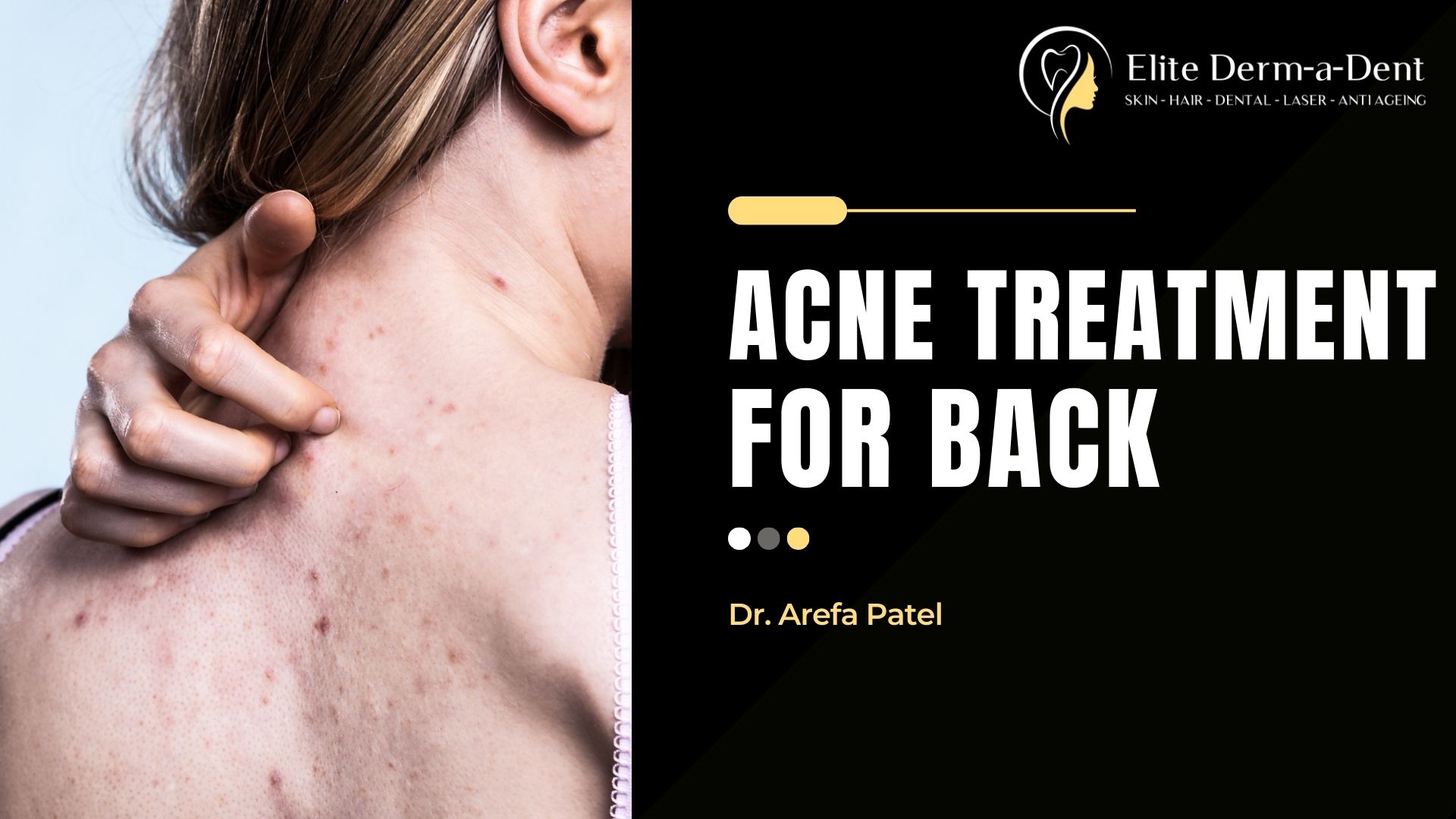 Acne Treatment for Back