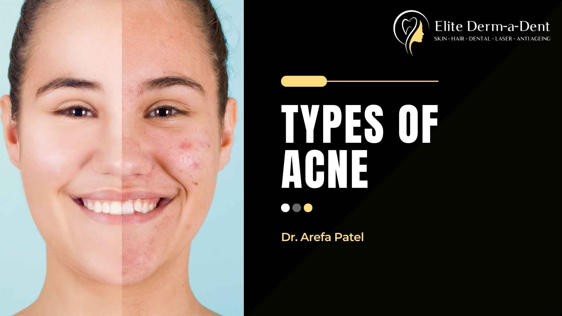 Dr. Arefa Patel explaining types of acne and treatment options