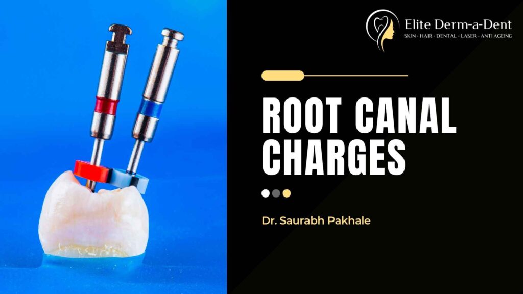 Root Canal Charges