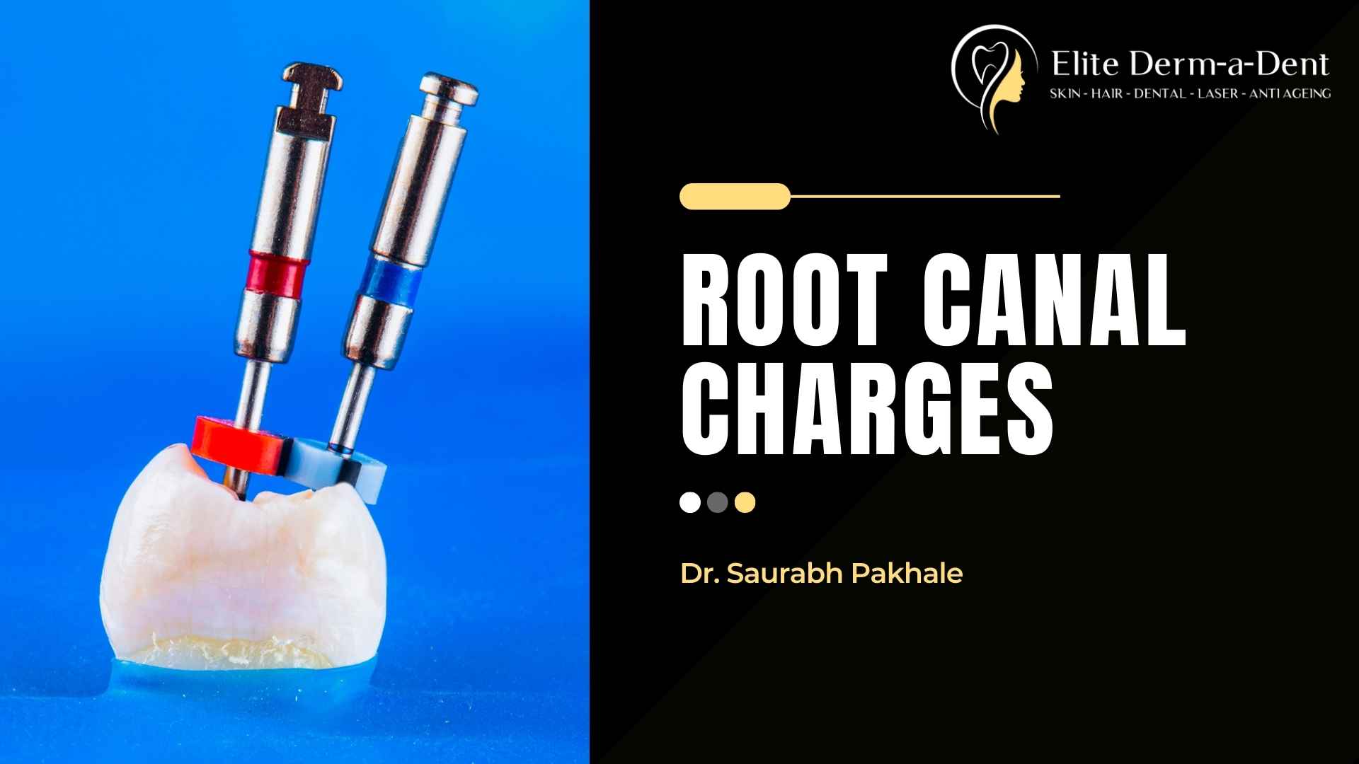 Root Canal Charges