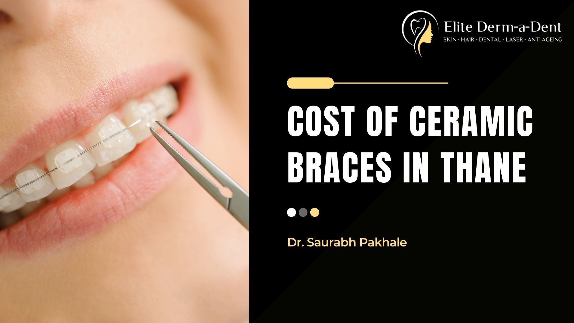 cost of ceramic braces in thane