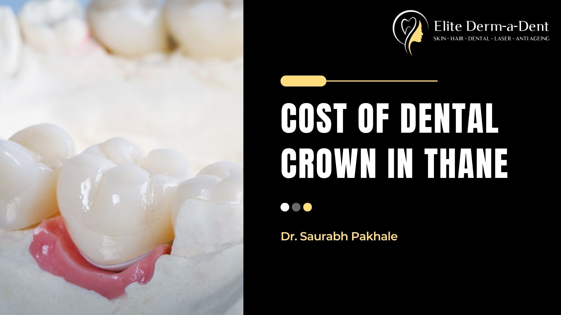 cost of dental crown in thane