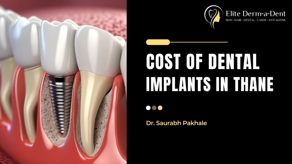 cost of dental implants in thane