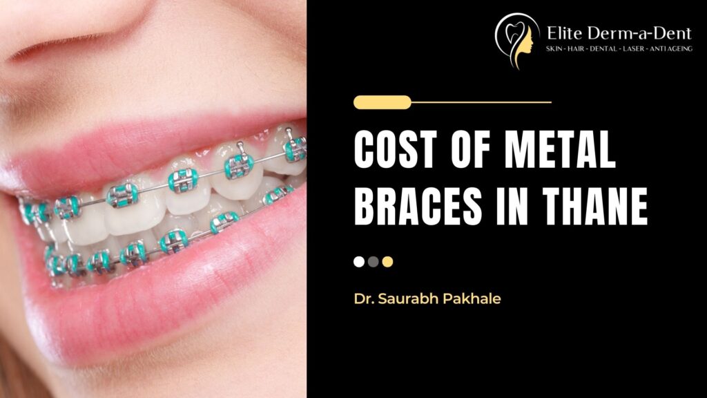 cost of metal braces in thane