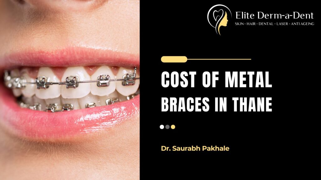 Cost of Metal Braces in Thane